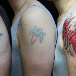 tattooの除去ランキング